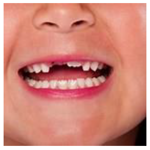 Let your dentist know if your child has lost any teeth